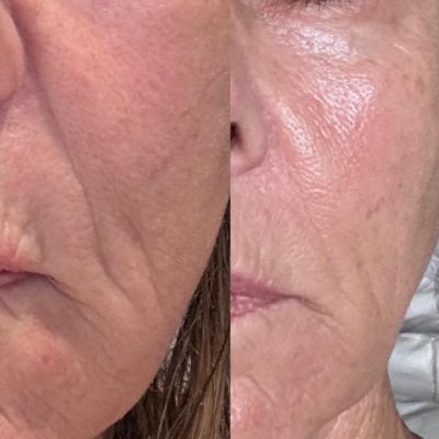 before and after mermaid facial aka salmon sperm facial near me at evolvmd milwaukee