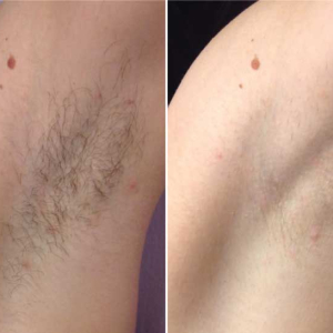 Armpit laser hair removal before and after