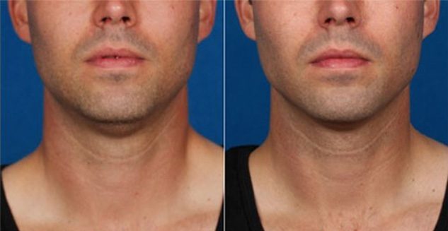 Kybella Non-Surgical Injectable to treat double chins.