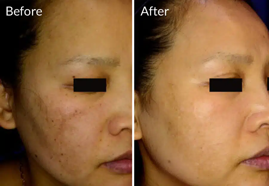 Focus Skin Rejuvenation uses the PicoSure Laser to minimize wrinkles, fine lines, age spots, brown spots, stretch marks at EvolvMD Medical Spa & Body Contouring in Milwaukee, WI, Pewaukee, New Berlin, Oakcreek, Shorewood, WI, Mequon Wi