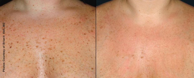 Before & After Forever Young BBL Photofacial - Chest