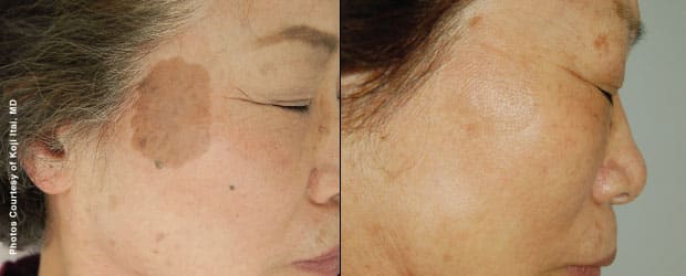 Before & After Forever Young BBL Photofacial - Birthmark