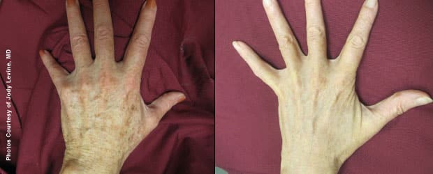 Before & After Forever Young BBL Photofacial - Hands