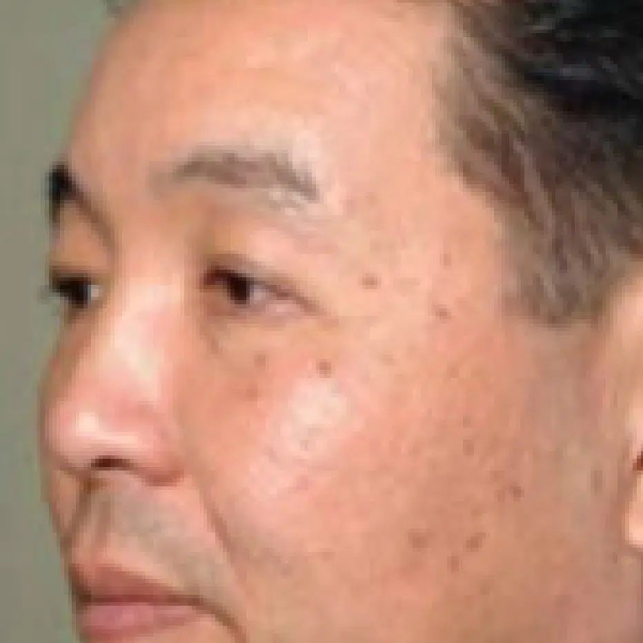 A close-up of a person's getting Fractional Skin Resurfacing