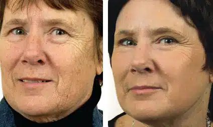 Fractional Laser Skin Resurfacing at EvolvMD Medical Spa & Body Contouring in Milwaukee, WI, servicing Pewaukee, New Berlin Shorewood, Mequon, WI is used to treat moderate and severe wrinkles, resurfacing the face to give it a tighter and more toned complexion