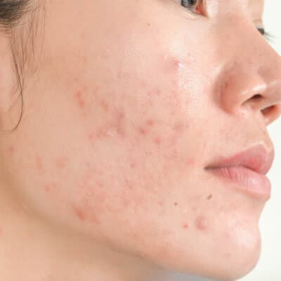 Our Services at EvolvMD Milwaulee, WI--treatment for Acne Scarring