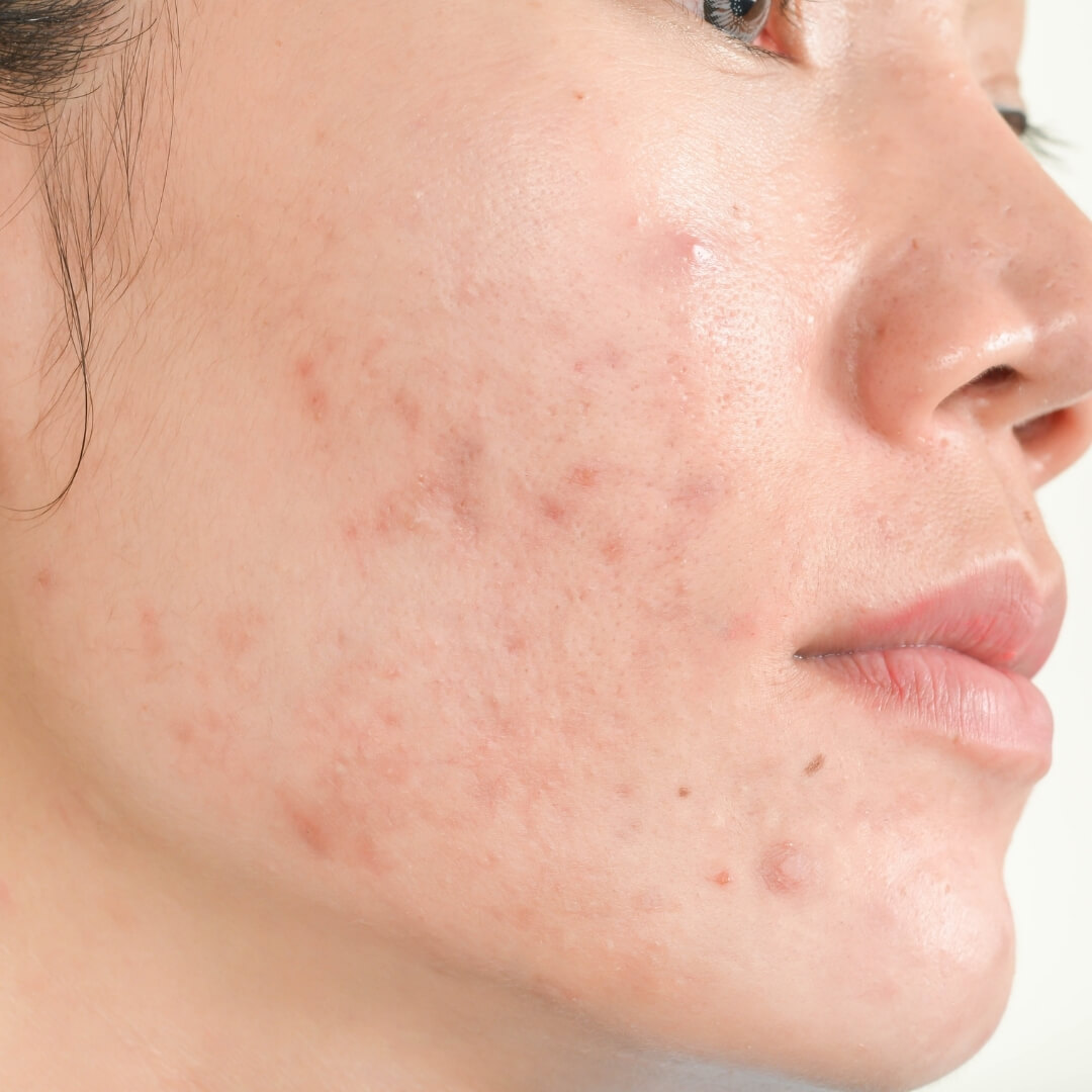 Get rid of acne and acne scarring near me