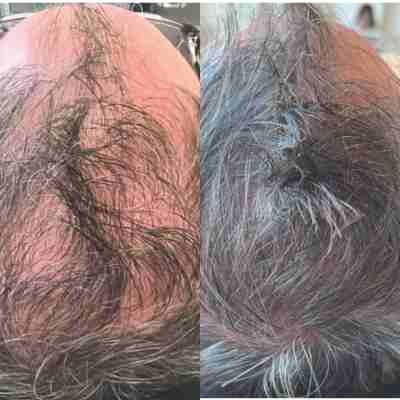 hair loss treatment milwaukee