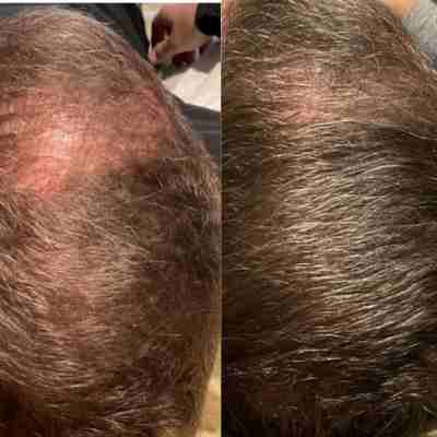 hair thinning treatment wauwatosa thinning treatment wauwatosa