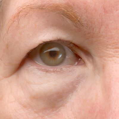 how to treat hooded eyelids without surgery near me milwaukee