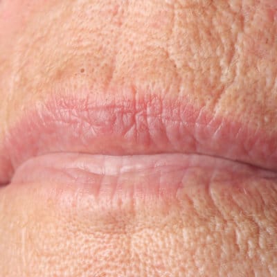 A person showing Smoker Lines/Vertical Lip Lines with​ Restylane, Restylane Kysse, & Restylane Silk
