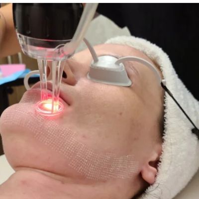 Fractional Laser Resurfacing