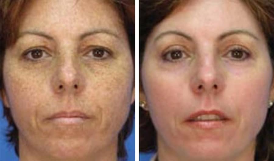 MicroLaserPeel Before & After Photos in Wauwatosa, WI