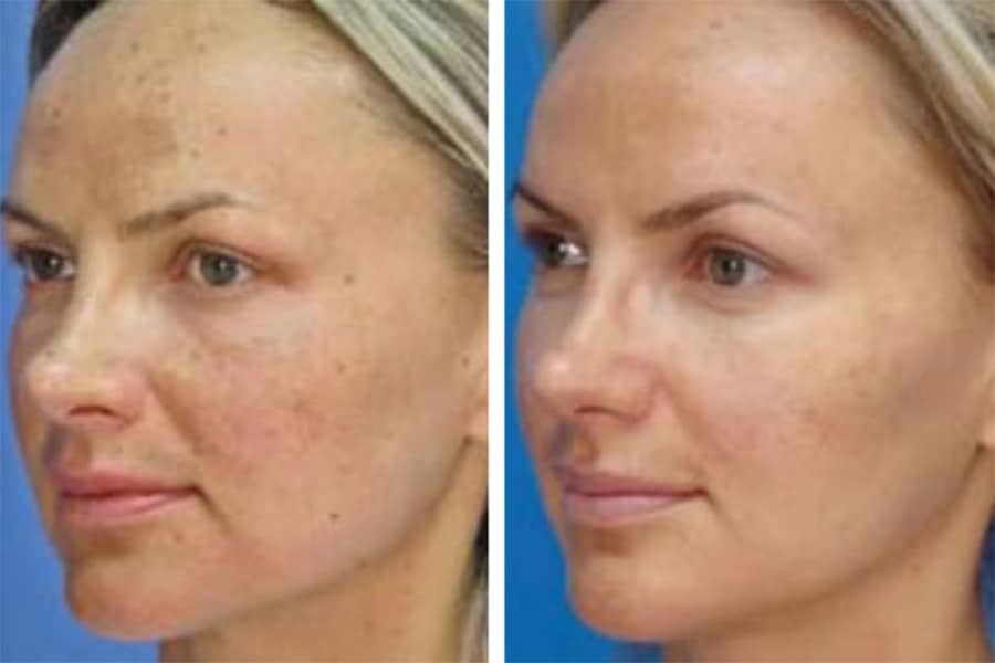 MicroLaserPeel Before & After Photos in Wauwatosa, WI