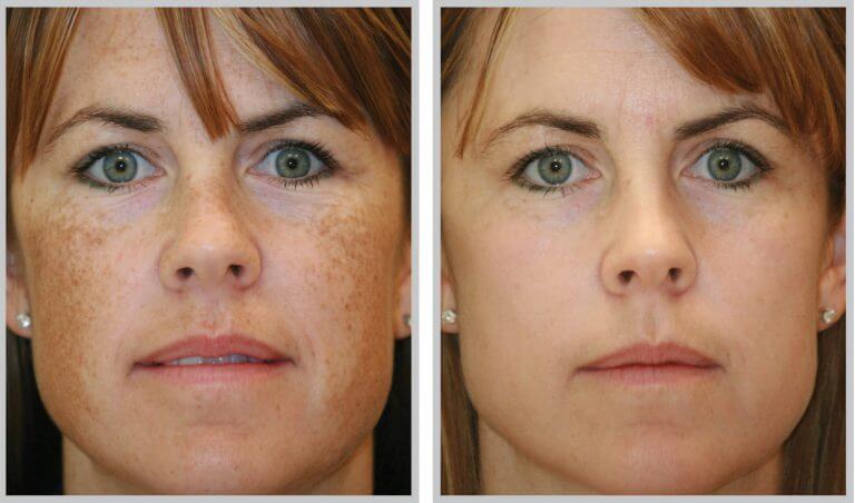 Microlaser Peel To Reverse Signs Of Aging, Acne Scarring And Sun Damage