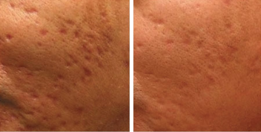 Before & After Microneedling Acne Scarring