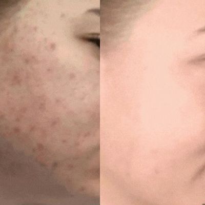 milwaukee biorepeel before and after evolvmd med spa near me