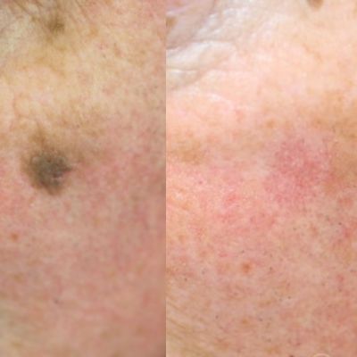 milwaukee wart removal c02 laser treatment near me evolvmd