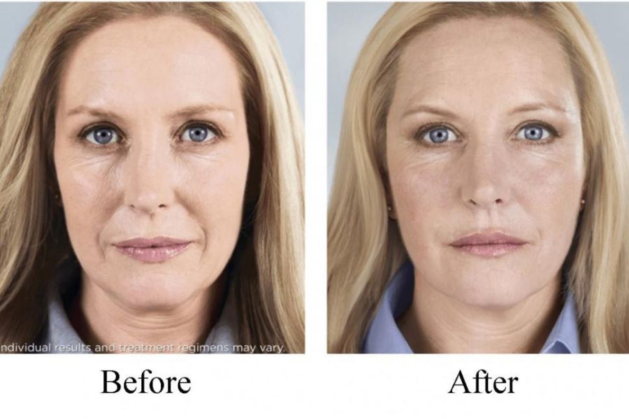 pretty woman before and after sculptra milwaukee