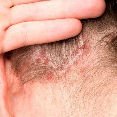 psoriasis treatment Milwaukee evolvmd med spa