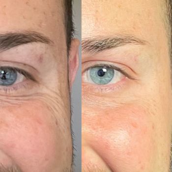 real botox before and after results wauwatosa