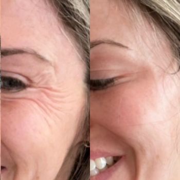 "Before and after Botox results, Milwaukee patient"