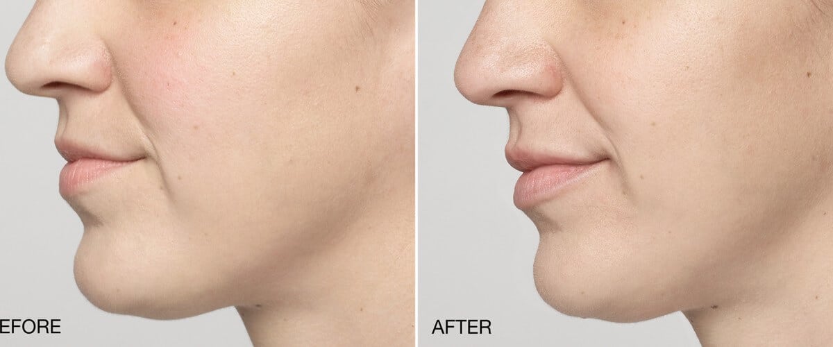 Restylane Filler in Milwaukee, WI, Before & After Photos