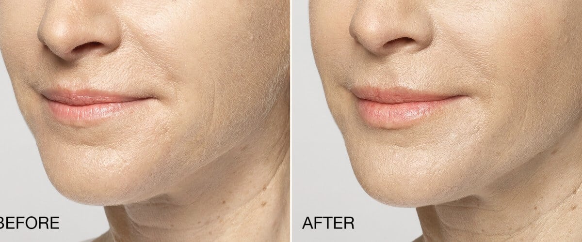 Restylane Filler in Milwaukee, WI, Before & After Photos
