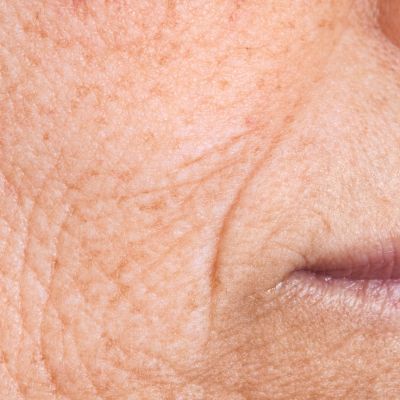 salmon sperm facial for skin tightening milwaukee