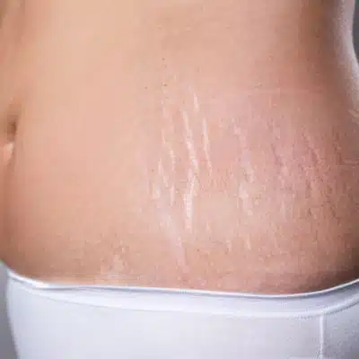 Body Treatments at EvolvMD Milwaukee include Scarlet RF for stretch marks and scaring.