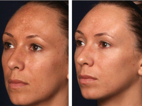 Before and after chemical peel