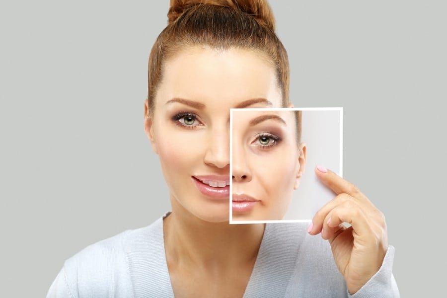 Photo of a woman before and after treating her smile lines