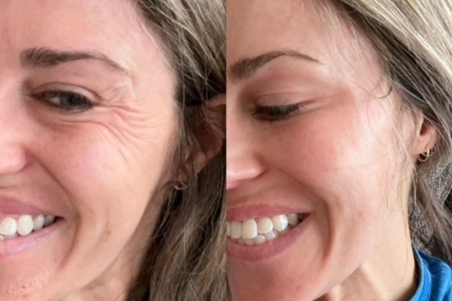 smiling woman before and after Botox Milwaukee for crows feet