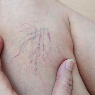 spider veins treatment near me milwaukee at EvolvMD Med Spa