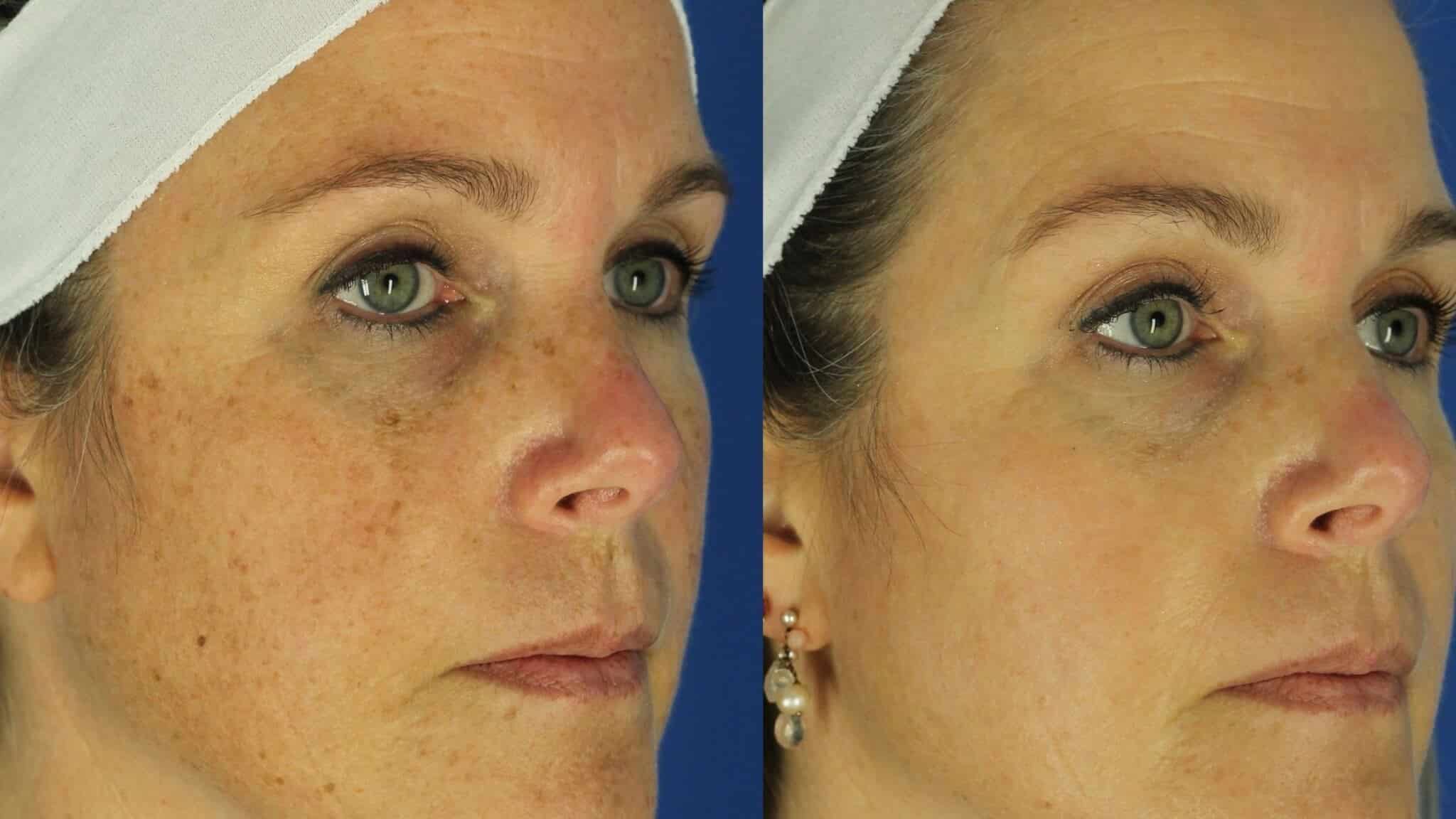 Supercharge Your BBL Photofacial at EvolvMD MedSpa in Milwaukee, WI