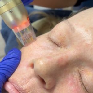 sylfirm rf microneedling near me