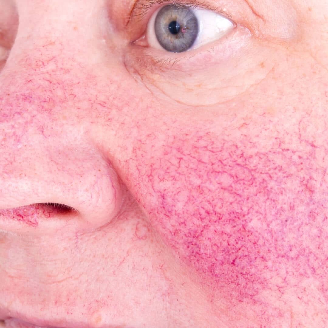 Treat redness from homonal imbalanced and rosacea at EvolvMD MedSpa & Body Contouring in Milwaukee, WI