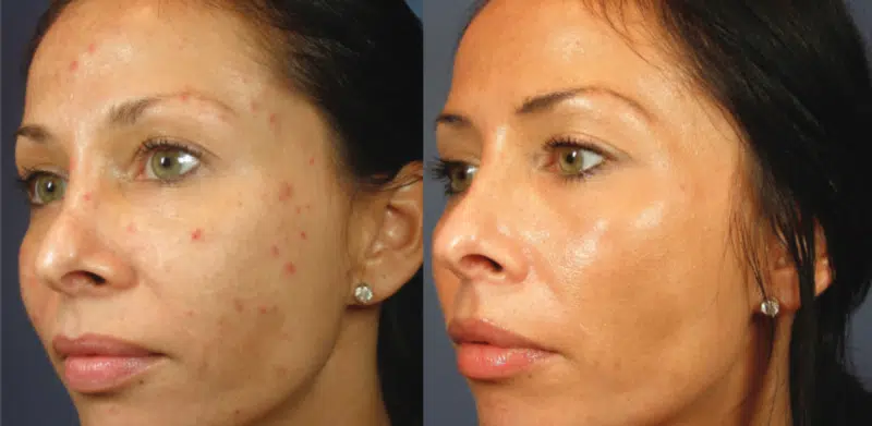 Vi Peel at EvolvMD MedSpa in Milwaukee, WI to achieve flawless skin, minmize pores, wrinkles and reduce the appearance of melasma