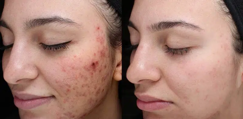 Vi Peel to treat melasma, cystic acne, acne scarring and more.