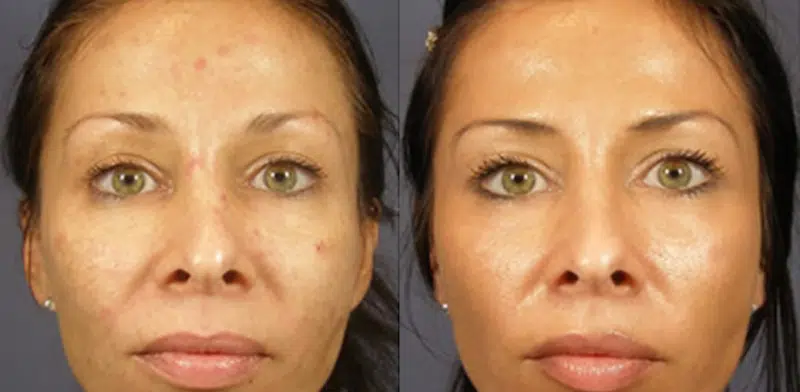Vi Peel to treat melasma, cystic acne, acne scarring and more.