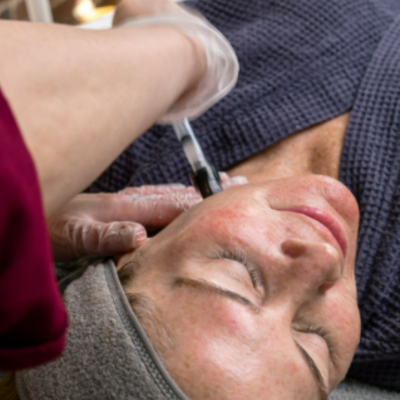 Woman getting a Mermaid Facial Milwaukee with Salmon Sperm PDRN